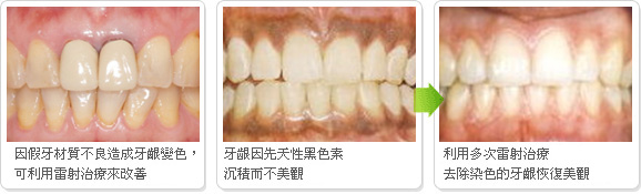 因先天黑色素沉积或因假牙材质不好造成牙龈染色,也可以利用雷射治疗